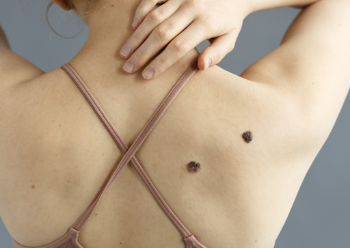 Skin Tag Removal