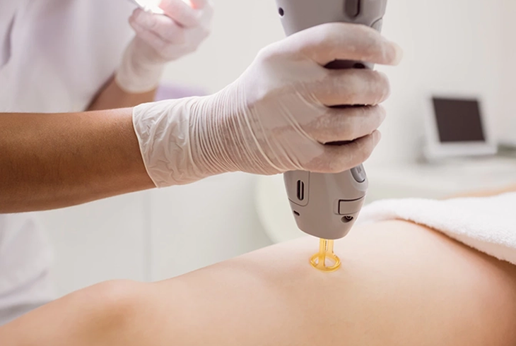 YAG-Laser